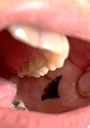 رقعة محملة بالإنسولين