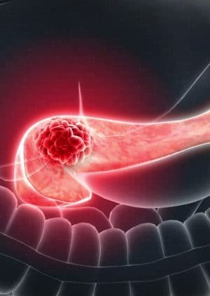 سرطان البنكرياس